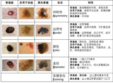 胸部長痣|痣是什麼？會變成黑色素瘤？7種一定要除的痣